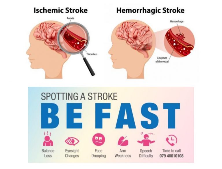 Neurosurgery in Brain Stroke Treatment by HCG Hospitals