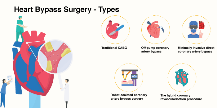 Heart Bypass Surgery - Types