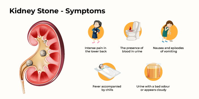 Kidney Stone - Symptoms