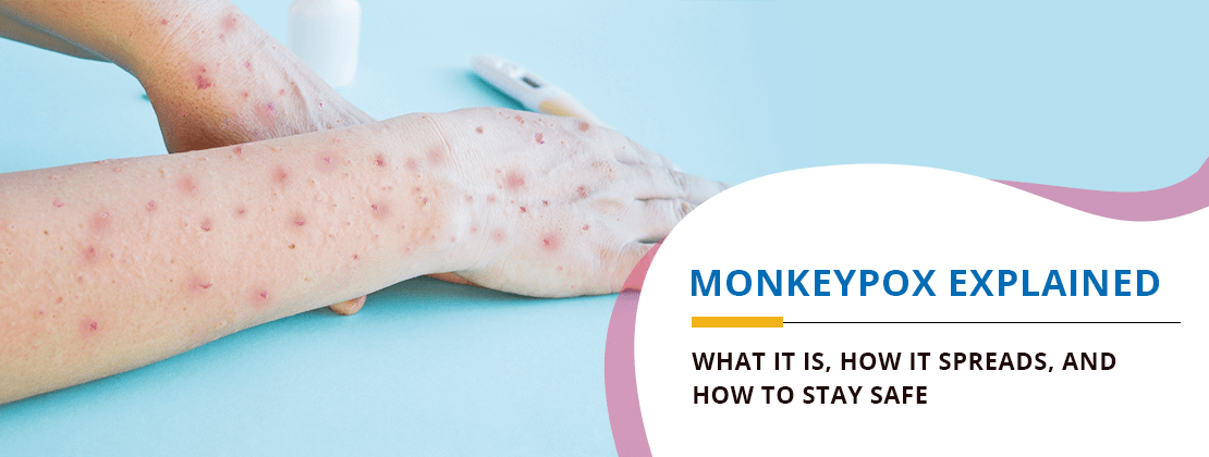 Monkeypox: symptoms, transmission & treatment guide