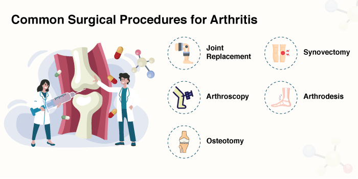 Arthritis: Surgical Procedures