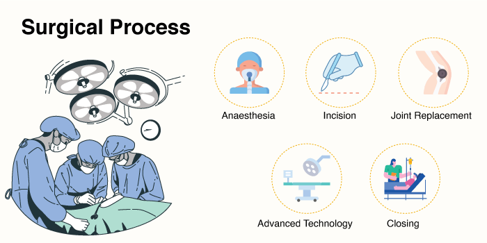 Knee Replacement Surgery - Surgical Process