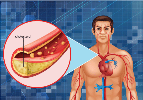 How Cholesterol Affects the Arteries: Cholesterol and Plaque Buildup