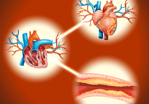 The Connection Between Cholesterol and Coronary Artery Disease