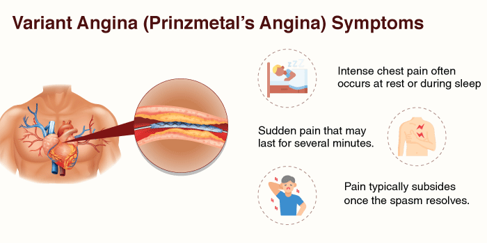 Define Variant Angina (Prinzmetal’s Angina)
