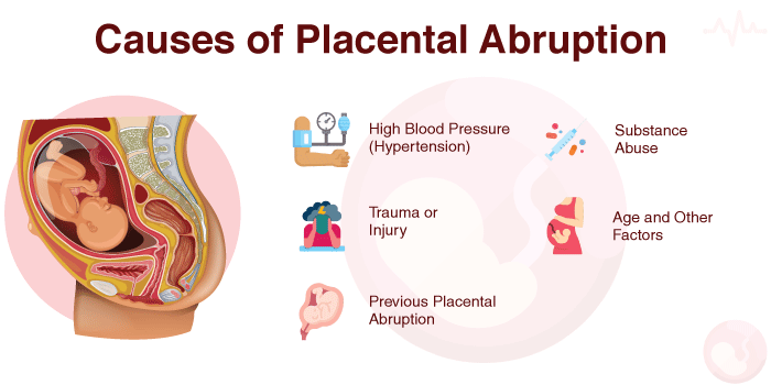 Causes of Placental Abruption